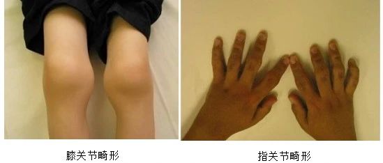 【健康知識(shí)】?jī)和P(guān)節(jié)痛需警惕致殘性?xún)和L(fēng)濕性疾病——幼年特發(fā)性關(guān)節(jié)炎